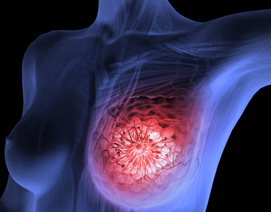 Breast lumps  Beacon Health System