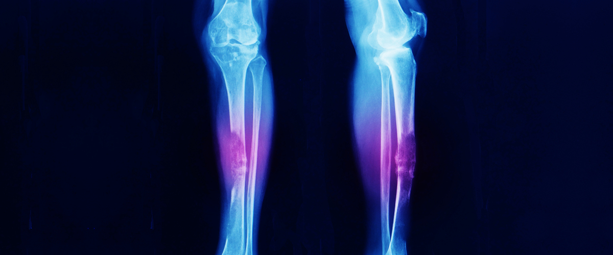 Bone Cancer Tissue Samples and Matched Bio-Fluids - Bay Biosciences