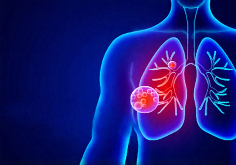 Tuberculosis Samples