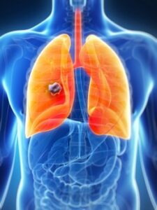 What’s the difference between small-cell lung cancer (SCLC) and non-small cell lung cancer (NSCLC)?